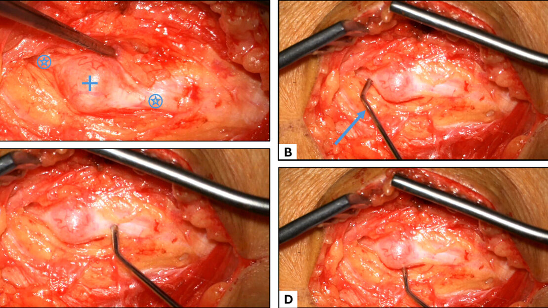 Endoskopische Abbildung eines Eingriffs bei einer Tumor-OP