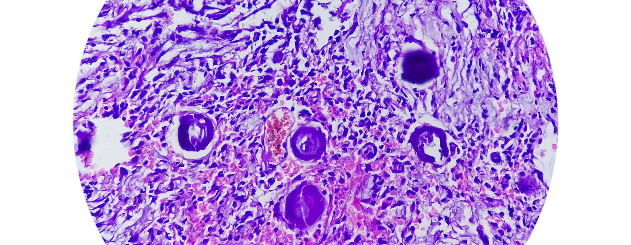 Tumorbiopsie