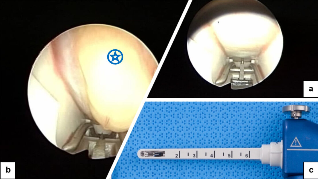 Endoskopische Abbildung Karpaltunnelsyndrom