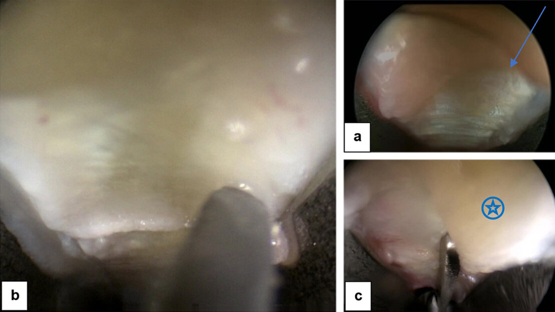 Endoskopische Abbildung Karpaltunnelsyndrom