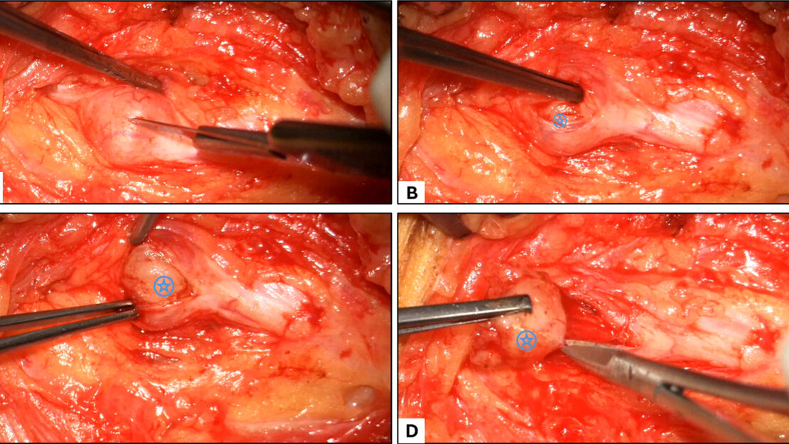 Endoskopische Abbildung eines Eingriffs bei einer Tumor-OP