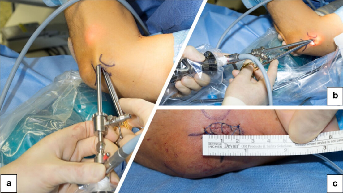 Endoskopische Abbildung Karpaltunnelsyndrom